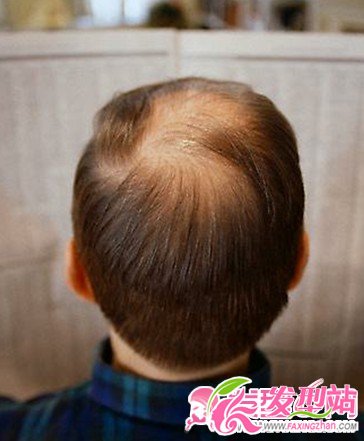 決絕脫發(fā) 拯救脫發(fā)危機(jī)大作戰(zhàn)